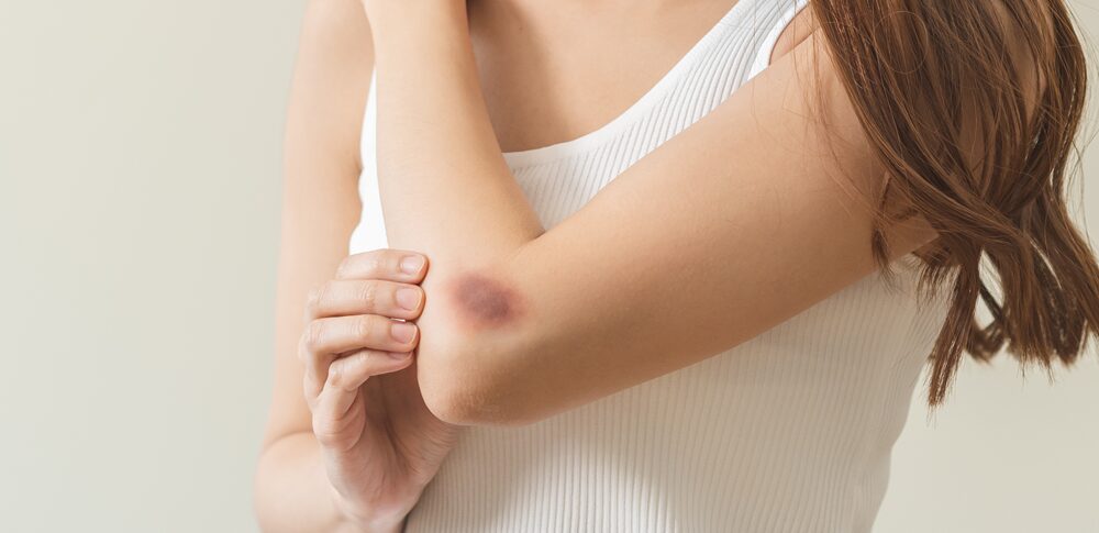 「突然あざができる」スピリチュアルな意味 なぜ身体に現れる?魂が伝える5つのメッセージと内面の癒し方