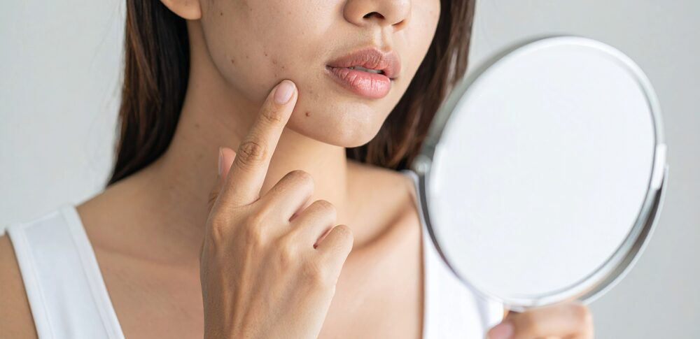 顎ニキビ（右側）のスピリチュアル的な意味は？｜状況・場所・人物・色別など30選を解説